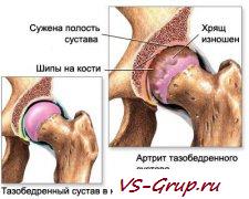 Суставы и вязки. Укрепление и возрождение суставов и вязок.