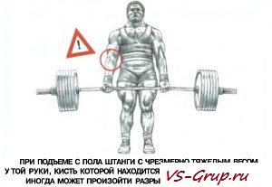 Разрыв бицепса