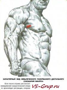 Разрыв бицепса